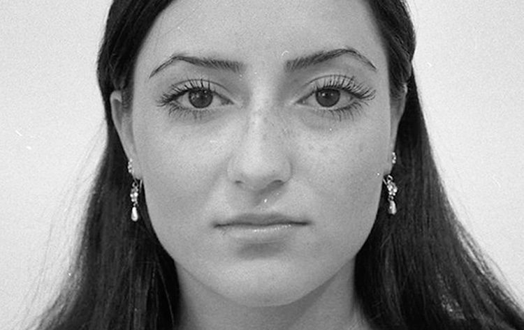 Einfache Höckernase. Vor der Operation.