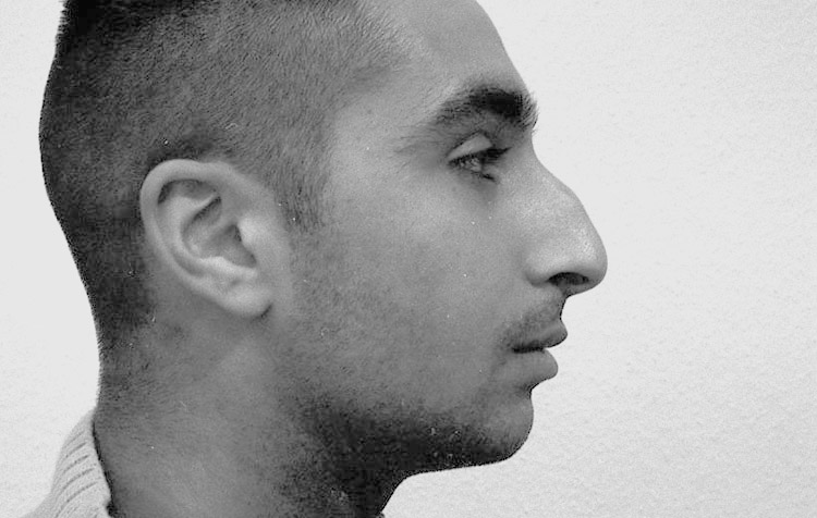 Höcker-Langnase vor der Operation
