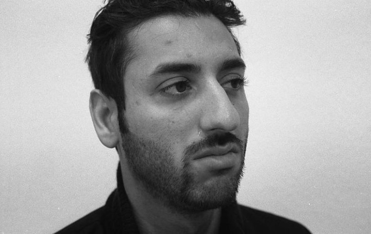 Höcker-Langnase, großbogig mit breiter Spitze. Vor der Operation.