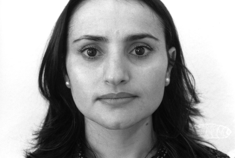 Höcker-Langnase mit breiter Spitze. Vor der Operation.