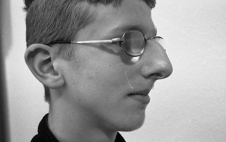 Riesennase. Brillensteg schneidet tief in die Haut der Nasenwurzel. Vor der Operation. 